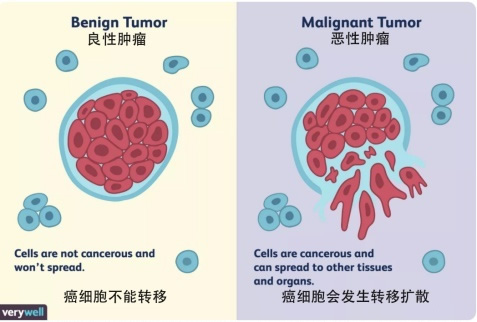 恶性肿瘤与良性肿瘤